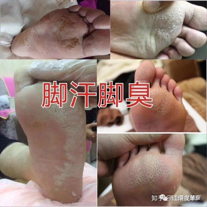 鳞屑脚气遇冷干裂脱屑