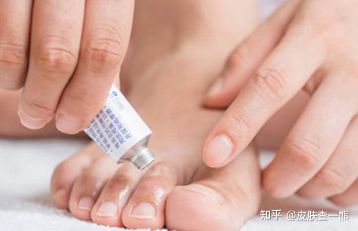 异味型脚气激素药膏滥用危害(图1) 异味型脚气激素药膏滥用危害
