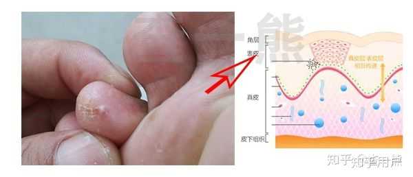 脚部水疱高温加速真菌繁殖