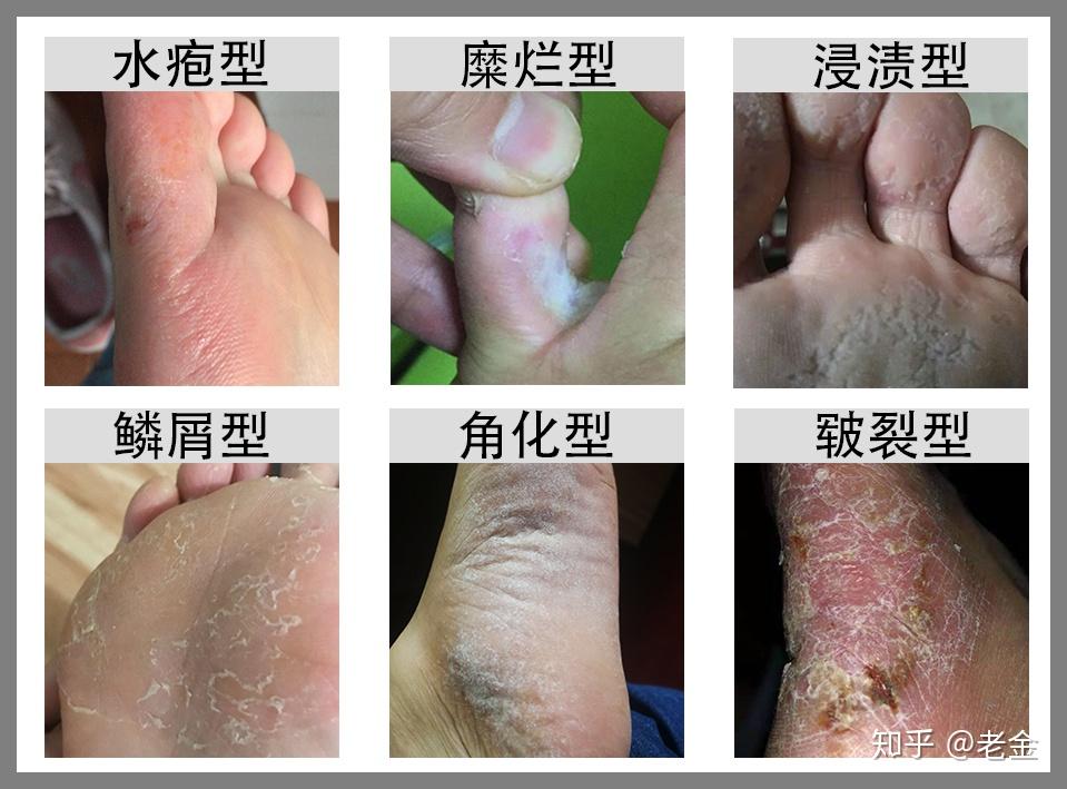 脚部水疱高湿度促进霉菌生长(图1) 脚部水疱高湿度促进霉菌生长