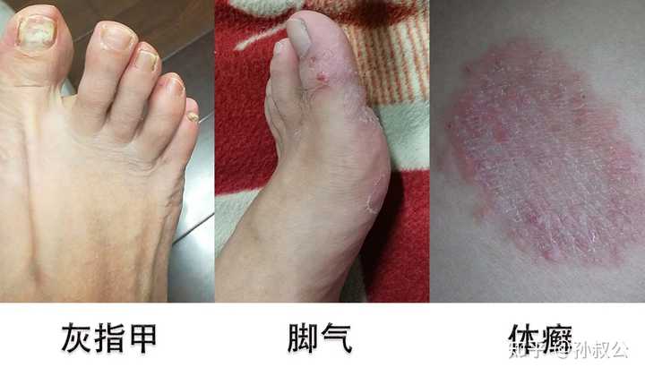 红斑型脚气抓挠禁忌