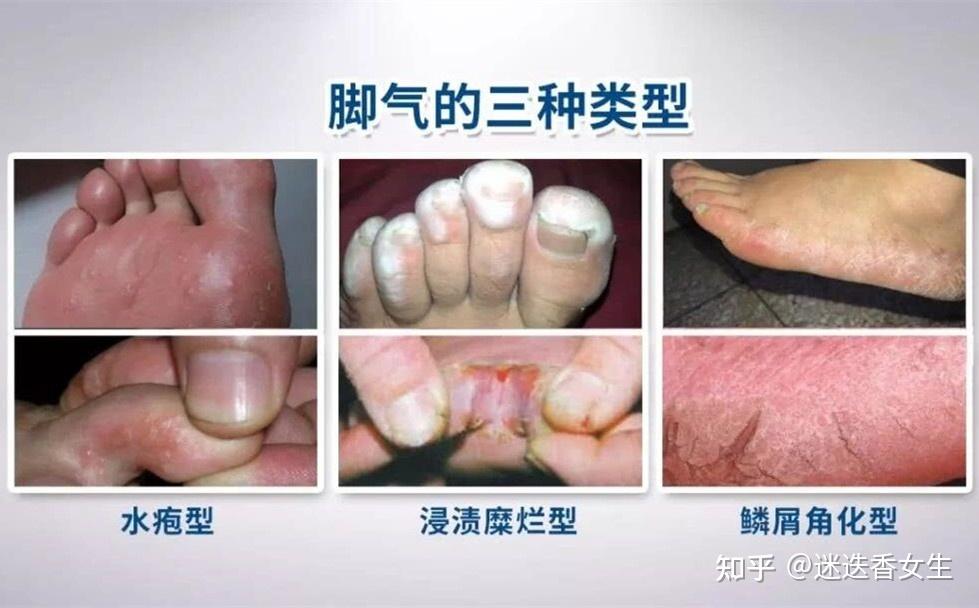 红斑型脚气外界刺激规避方法(图1) 红斑型脚气外界刺激规避方法