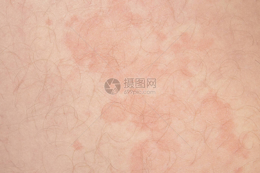 红斑型脚气宿舍消毒技巧(图1) 红斑型脚气宿舍消毒技巧