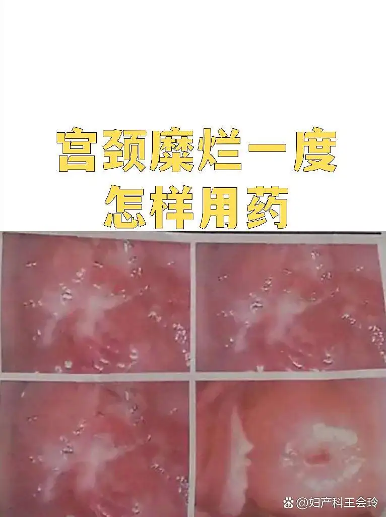 糜烂型脚气脚部定期干燥保养技巧(图1) 糜烂型脚气脚部定期干燥保养技巧