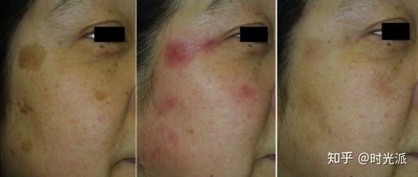 老人红斑舒缓修护