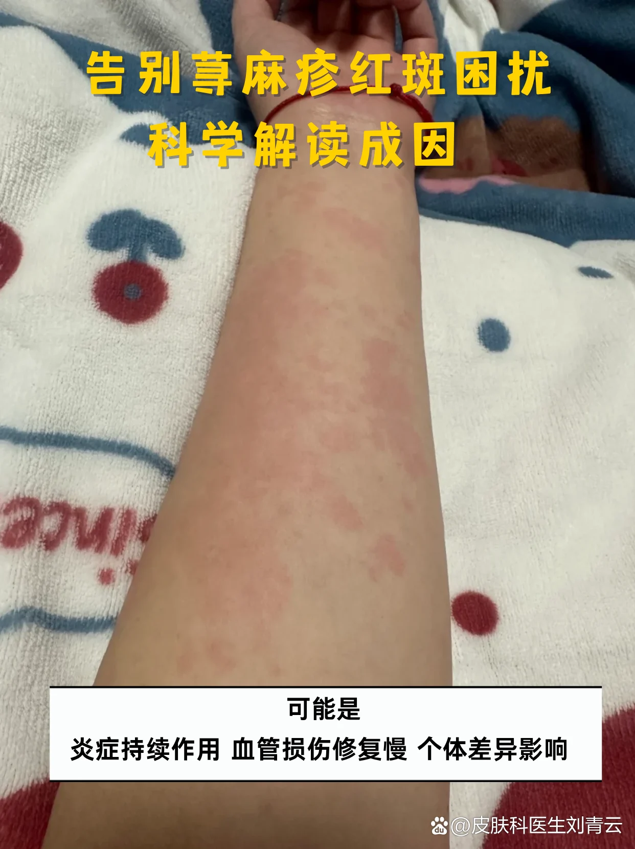 轻症红斑简易调理