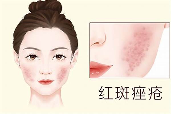 居家红斑护理治疗